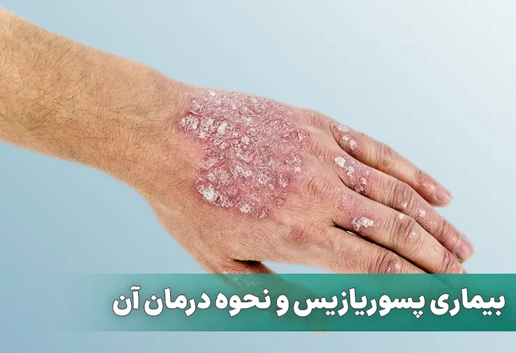 بیماری پسوریازیس