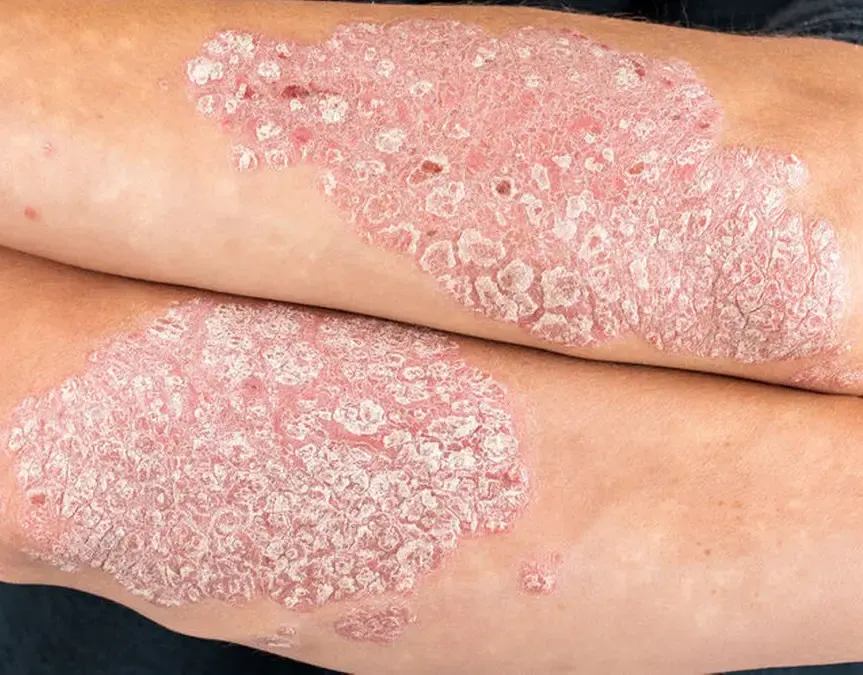 پسوریازیس پوست