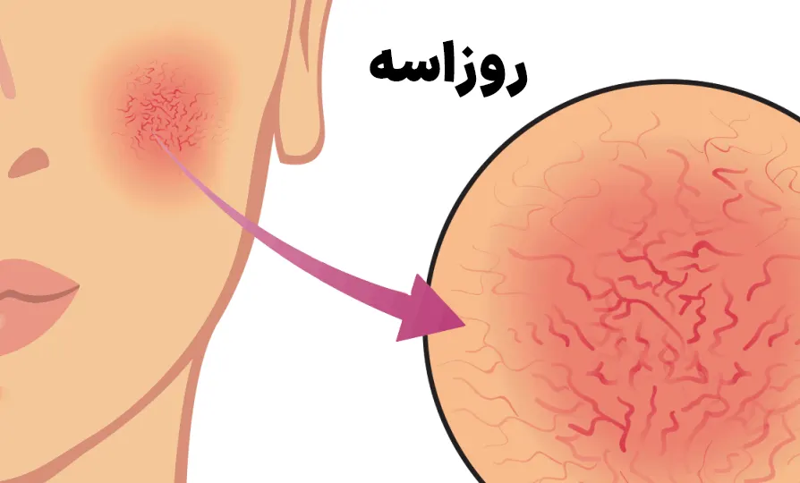 روزاسه چیست؟