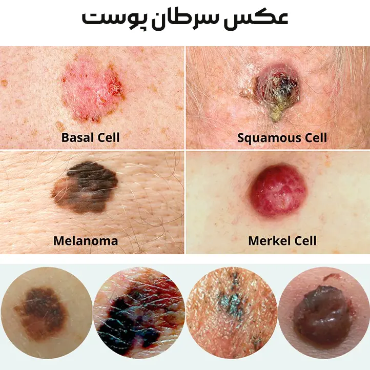 سرطان پوست