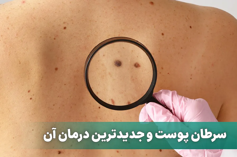 سرطان پوست و جدیدترین درمان آن