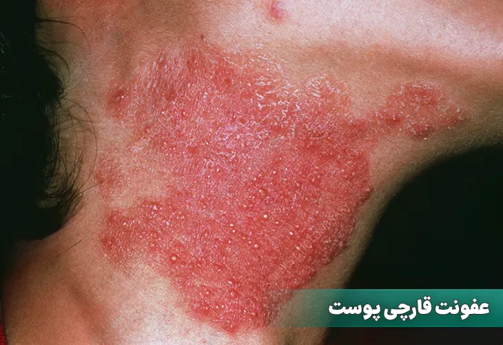 عفونت قارچی پوست