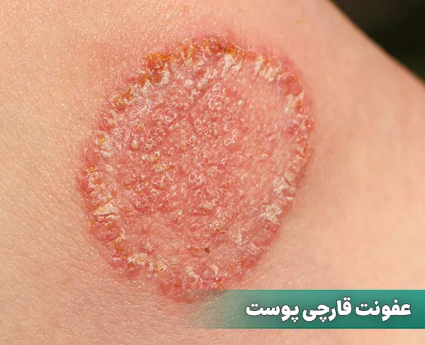 عفونت قارچی پوست