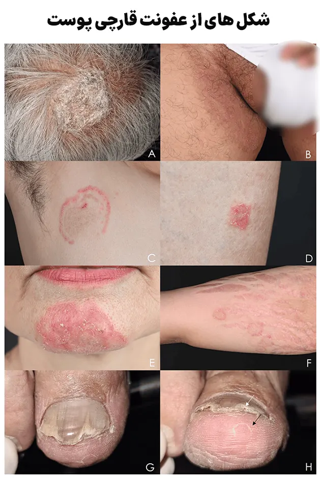 عفونت قارچی پوست