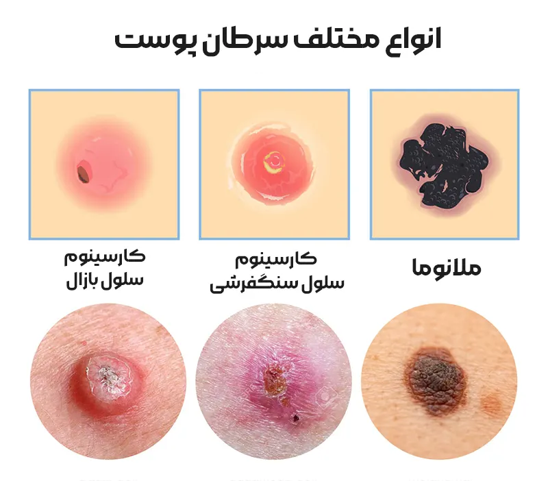 انواع مختلف سرطان پوست