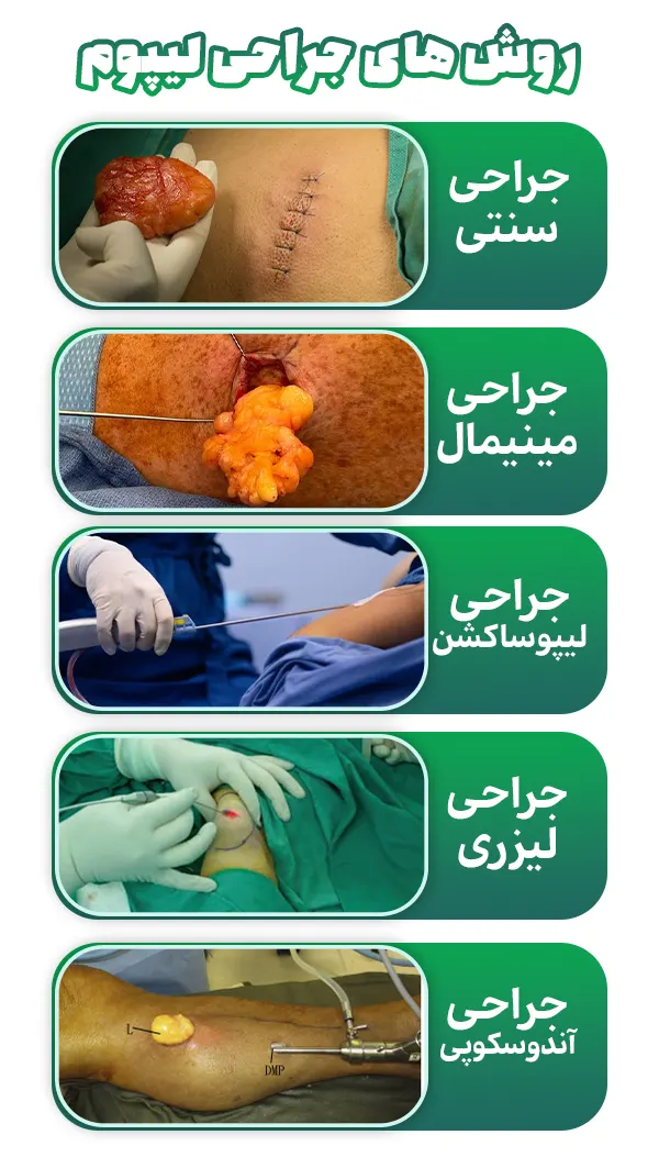 روش های جراحی لیپوم