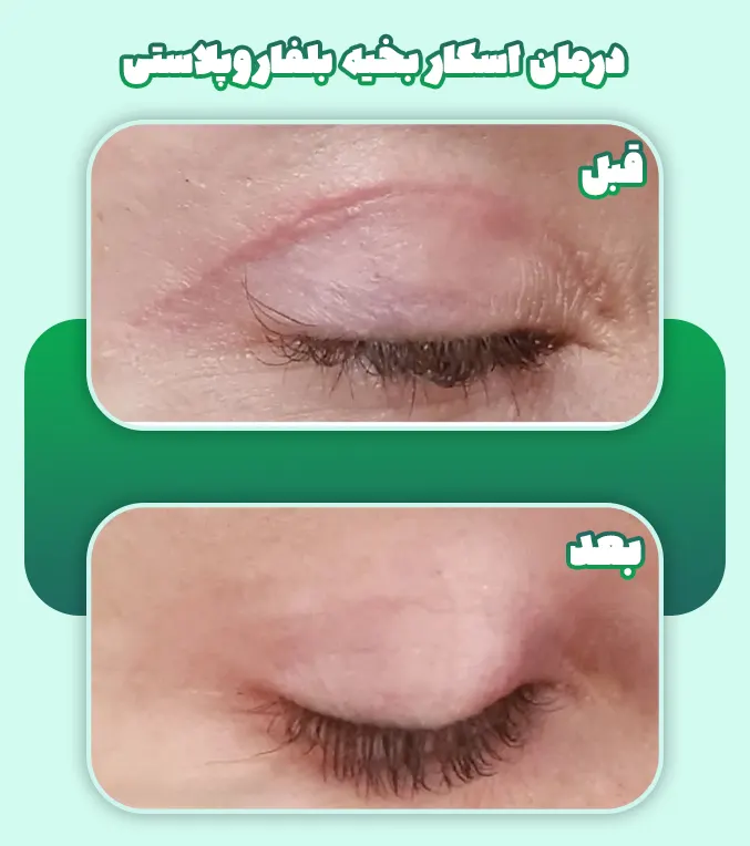 درمان اسکار بخیه بلفاروپلاستی