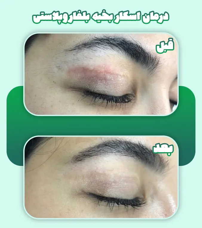 درمان اسکار بخیه بلفاروپلاستی