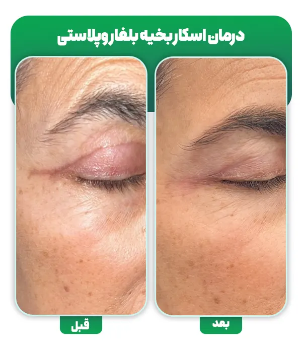 درمان اسکار بخیه بلفاروپلاستی