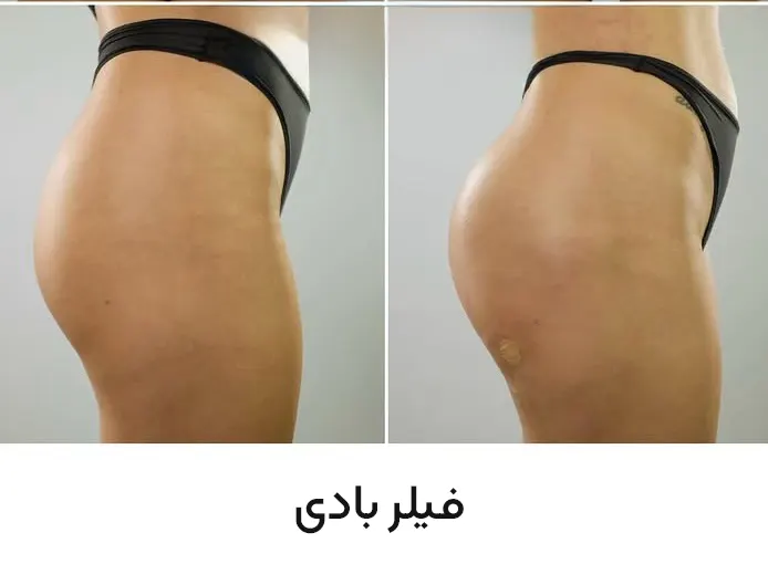 تزریق فیلر بادی