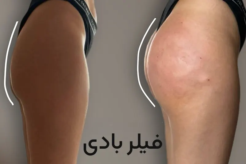 تزریق فیلر بادی