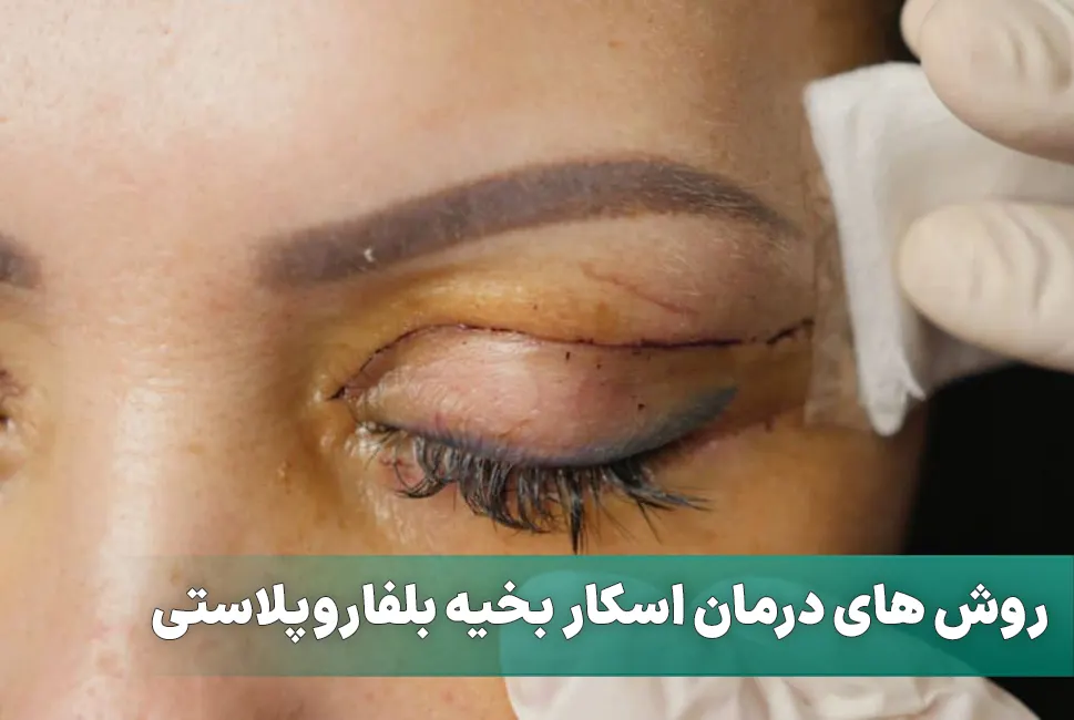 درمان اسکار بخیه بلفاروپلاستی