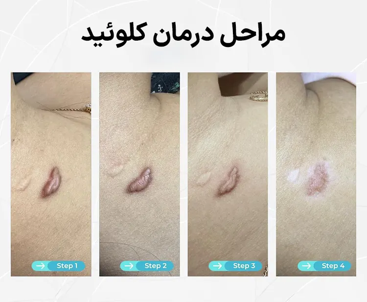 درمان کلوئید
