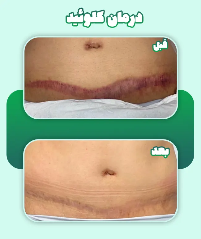 قبل و بعد درمان کلوئید