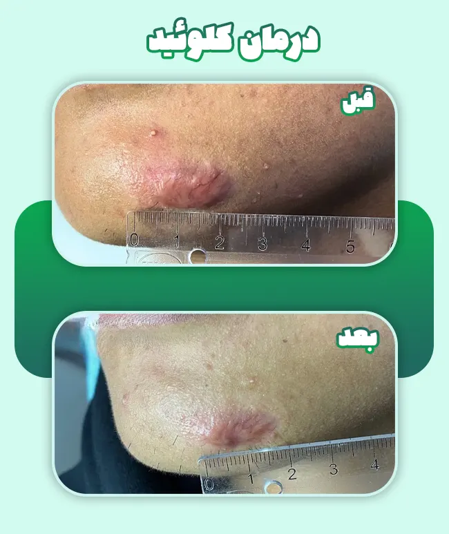 قبل و بعد درمان کلوئید