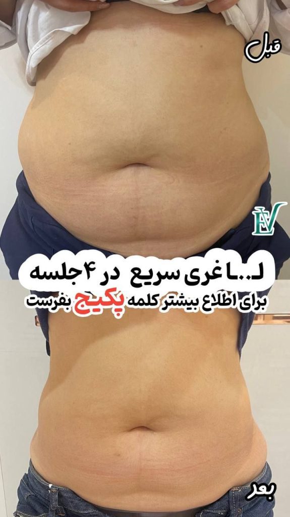 لاغری با آر اف