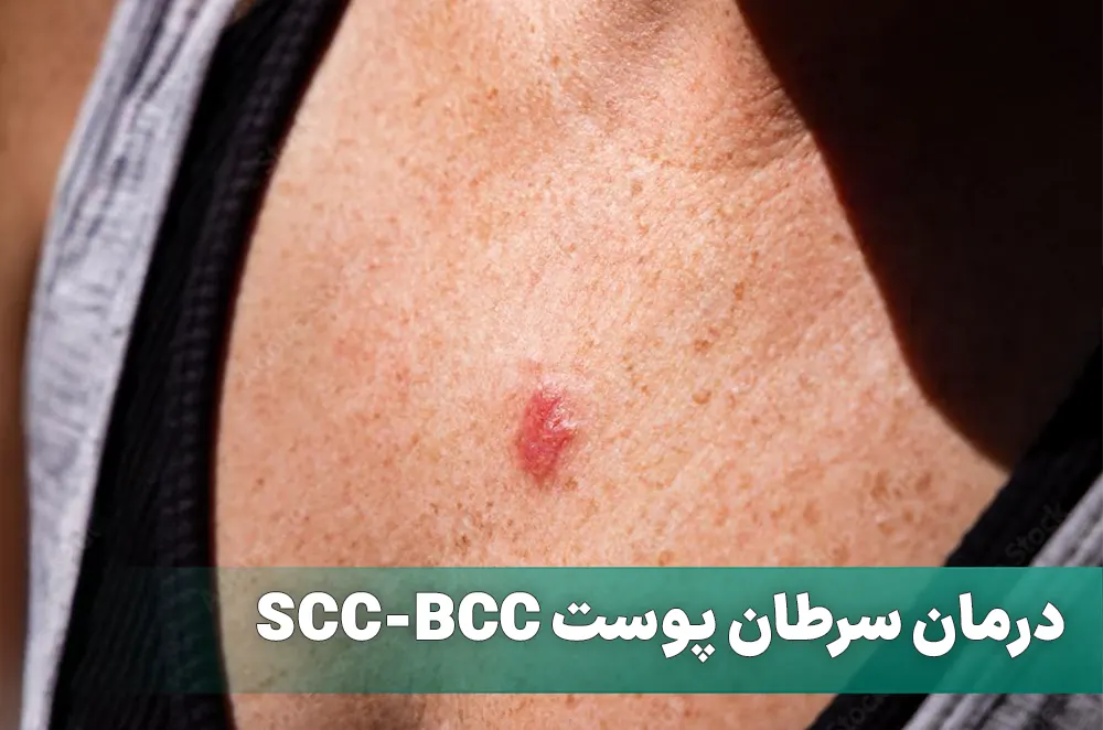 درمان سرطان پوست SCC-BCC در تهران