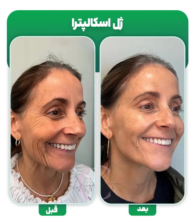قبل و بعد ژل اسکالپترا