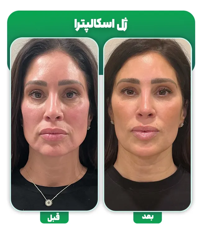 قبل و بعد ژل اسکالپترا