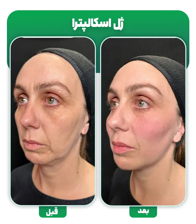 قبل و بعد ژل اسکالپترا