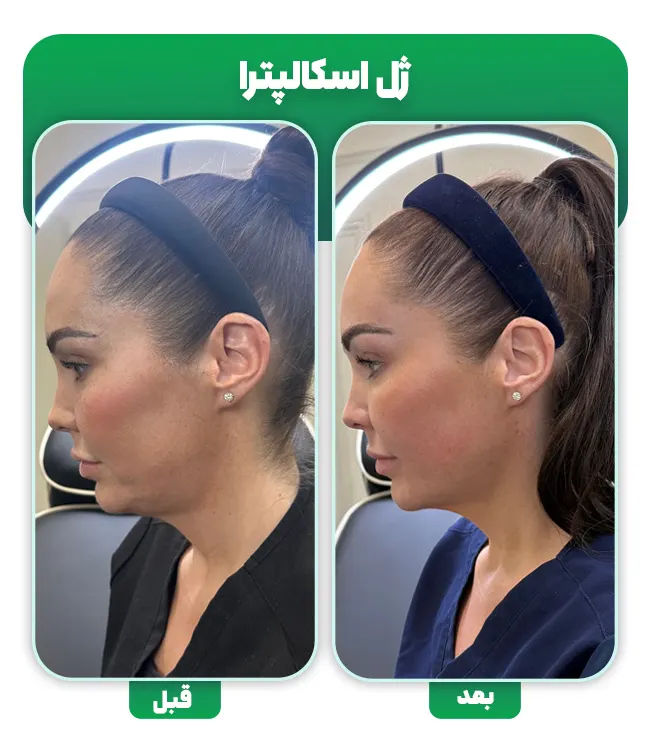 قبل و بعد ژل اسکالپترا
