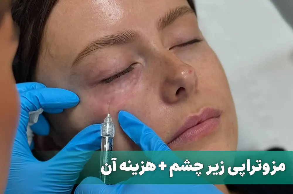 مزوتراپی زیر چشم