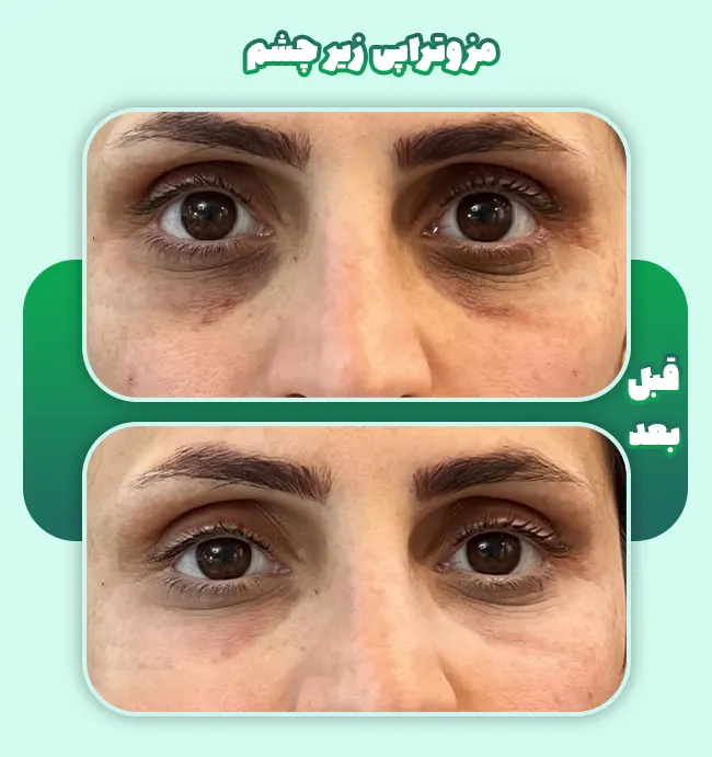 قبل و بعد مزو زیر چشم