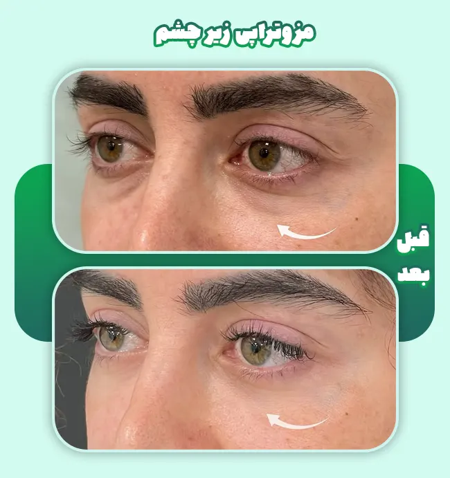 قبل و بعد مزو زیر چشم