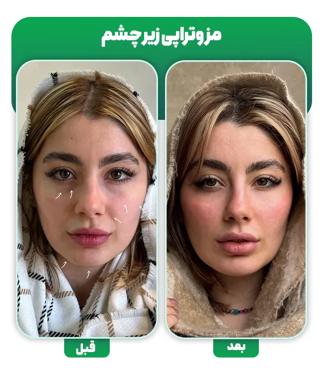 مزوتراپی زیر چشم