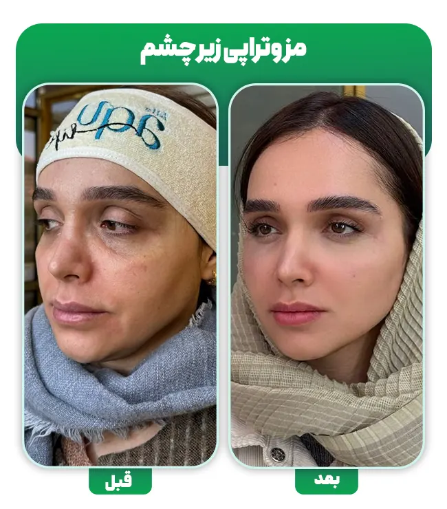 نتایج مزوتراپی زیر چشم