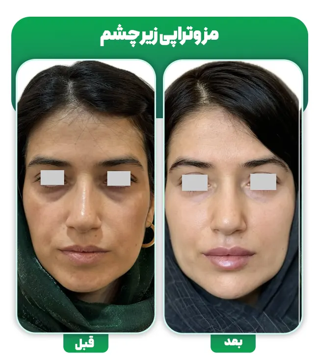 نتایج مزوتراپی زیر چشم