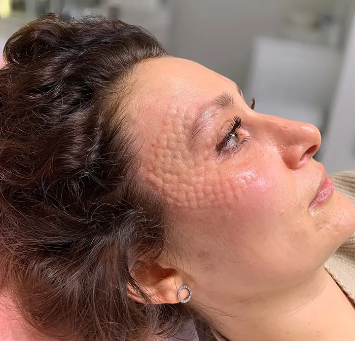 مزوتراپی زیر چشم