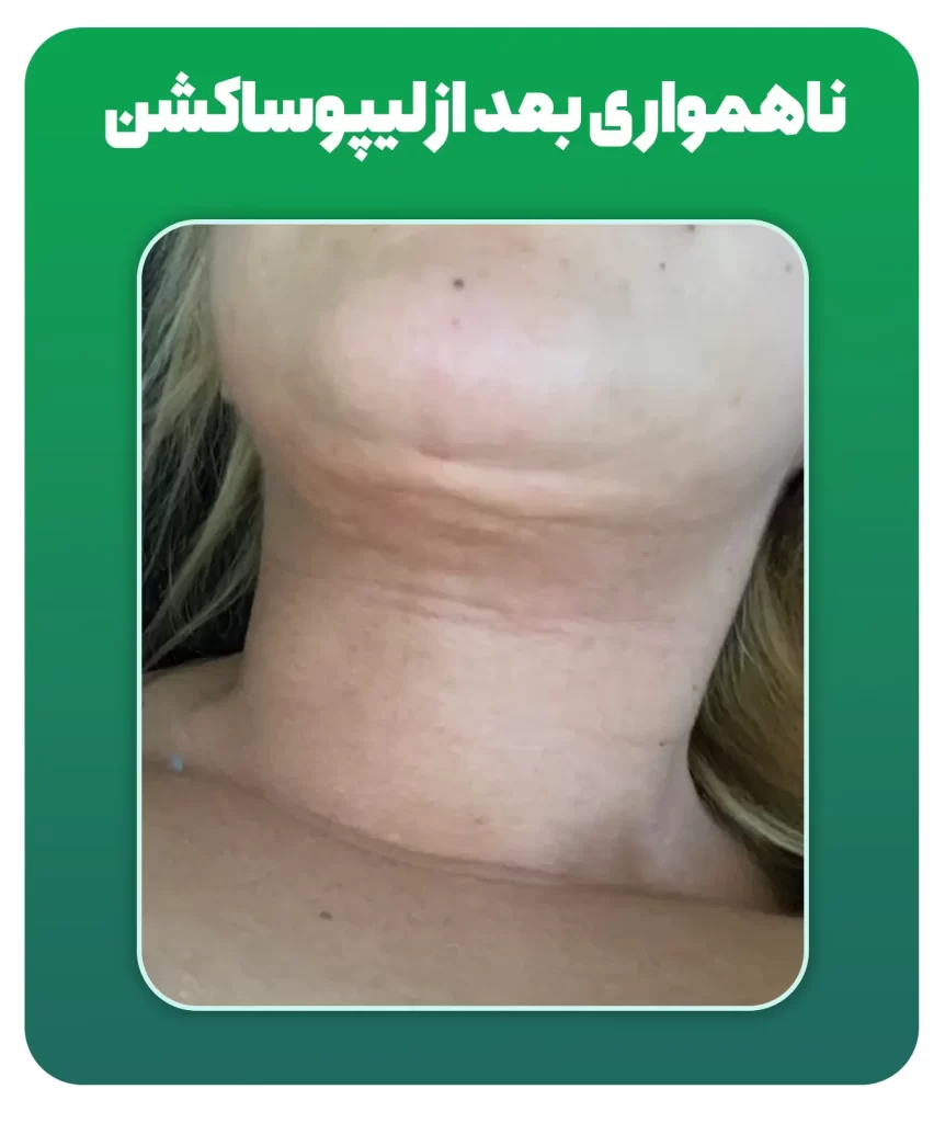 ناهمواری بعد از لیپوساکشن
