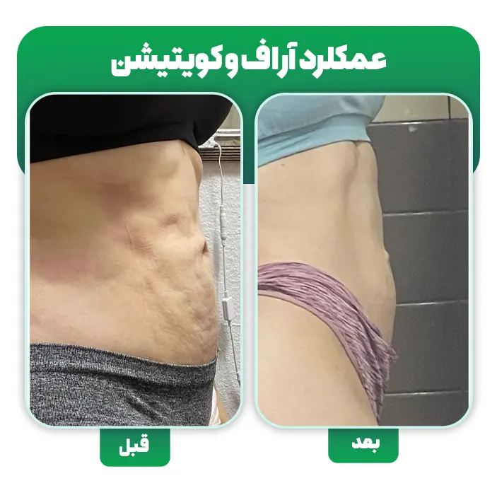 درمان ناهمواری بعد از لیپوساکشن