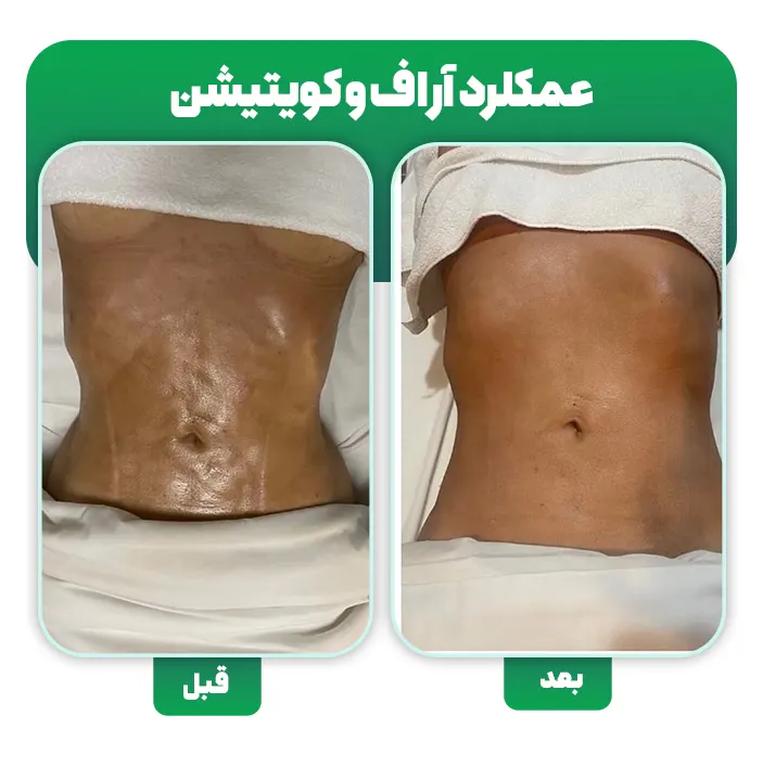 درمان ناهمواری بعد از لیپوساکشن