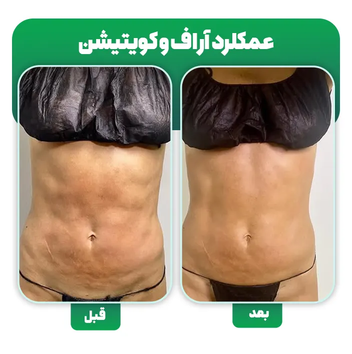درمان ناهمواری بعد از لیپوساکشن