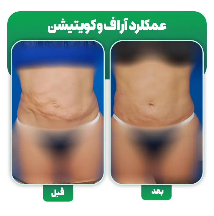 آر اف بعد لیپوساکشن