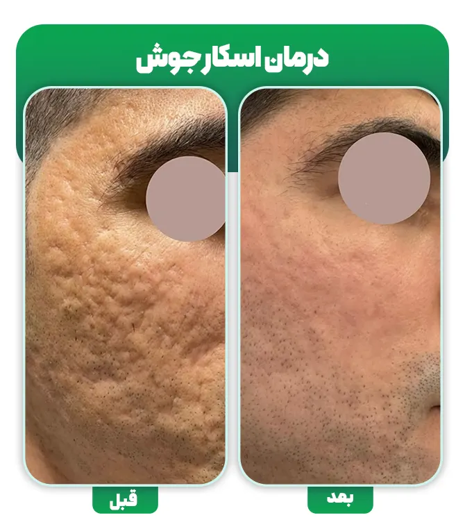 درمان اسکار جوش