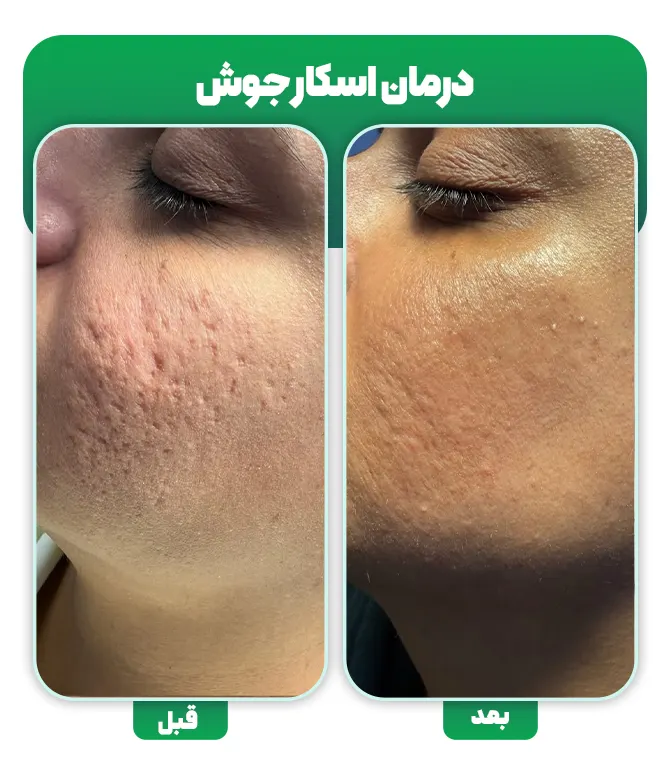 درمان جای جوش