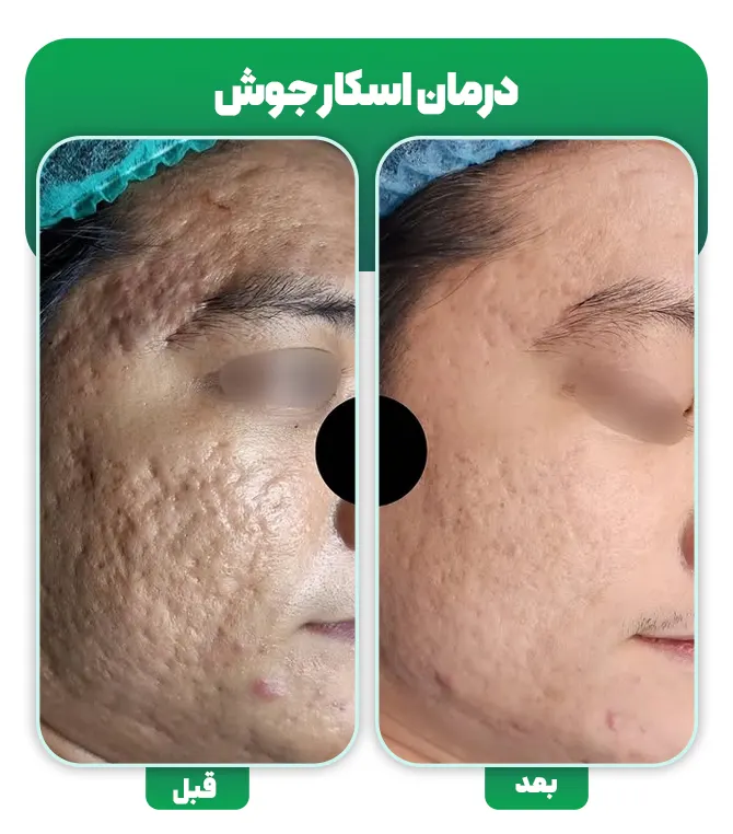 درمان جای جوش فرورفته