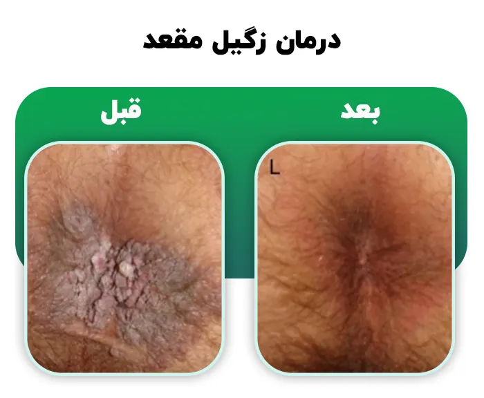 درمان زگیل مقعد