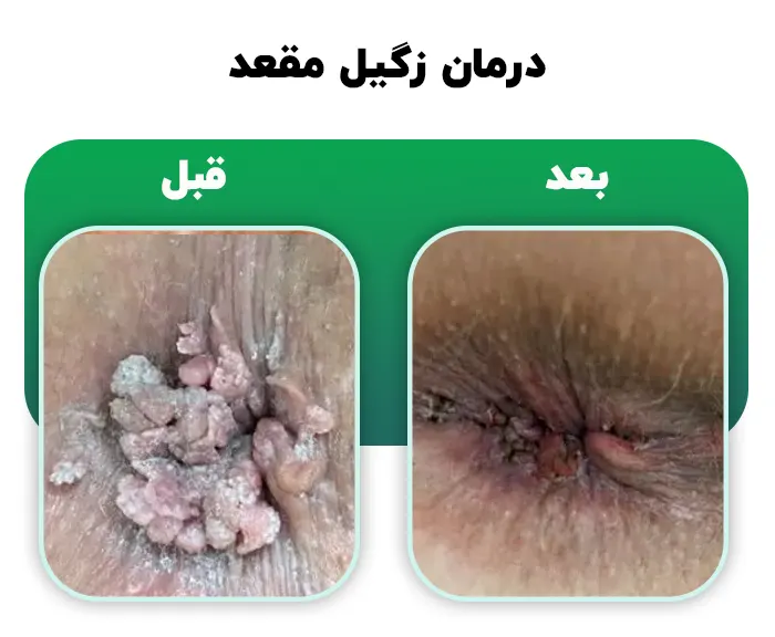 زگیل مقعد قبل و بعد