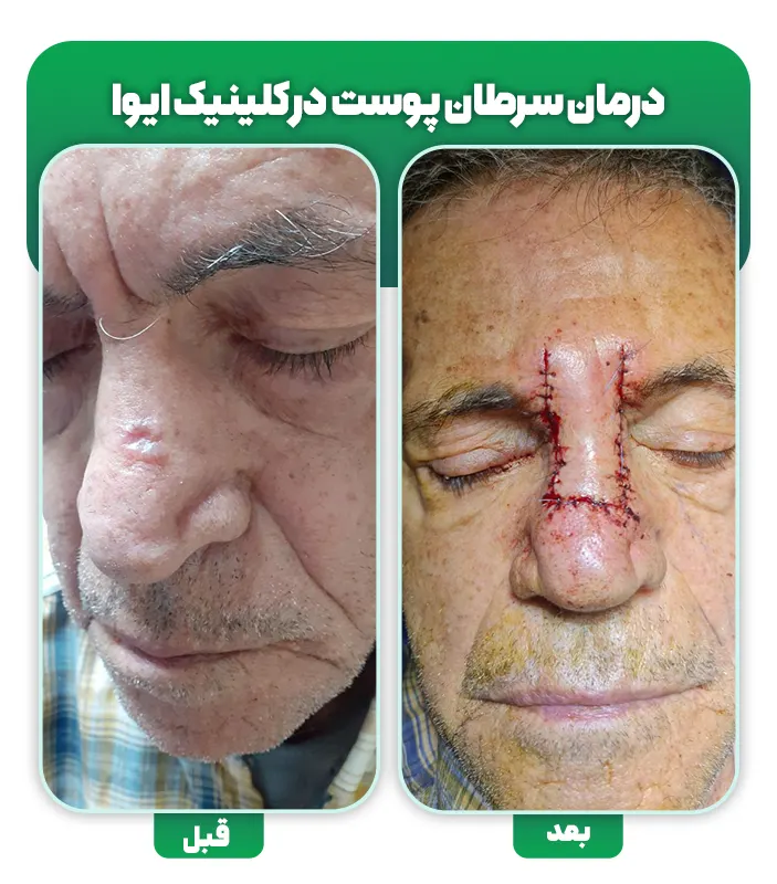 جراحی سرطان پوست SCC BCC