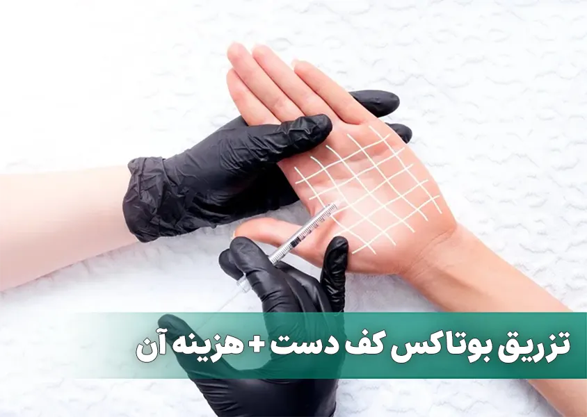 تزریق بوتاکس کف دست