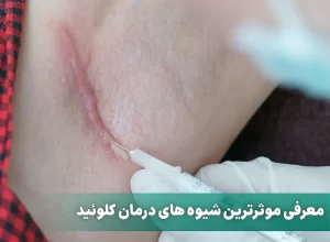 درمان کلوئید