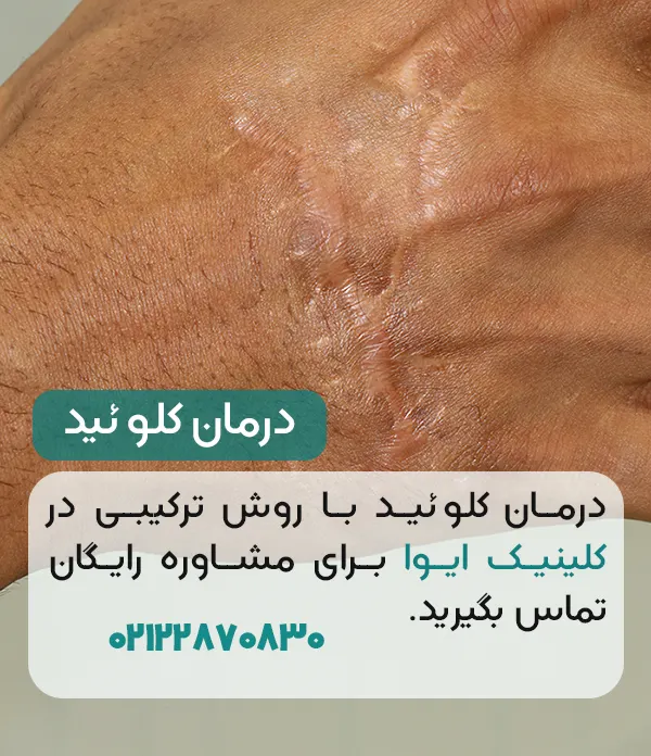 درمان کلوئید