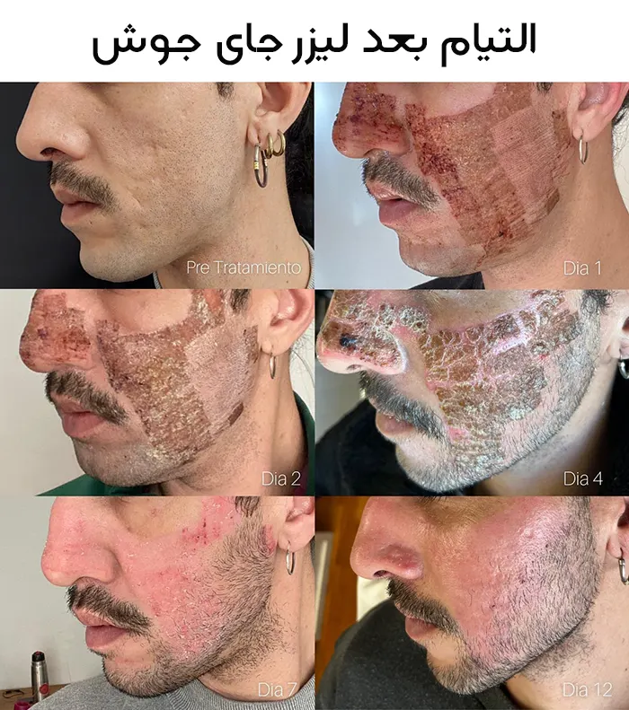 دوره نقاهت لیزر فرکشنال