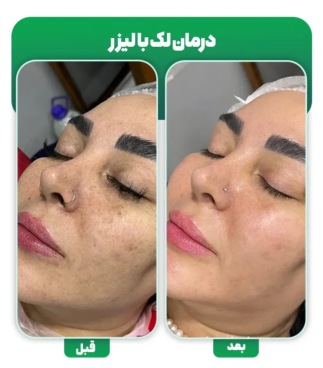 لیزر لک صورت