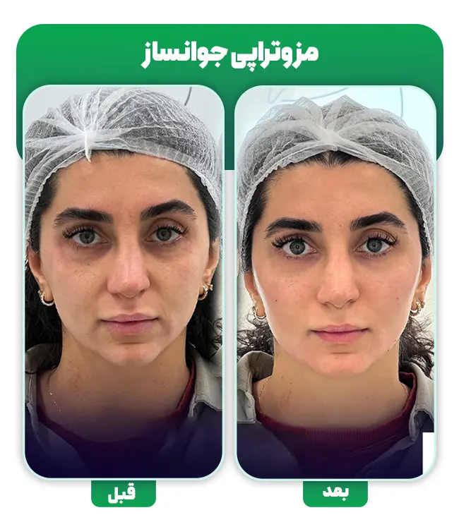 مزوتراپی جوانساز صورت