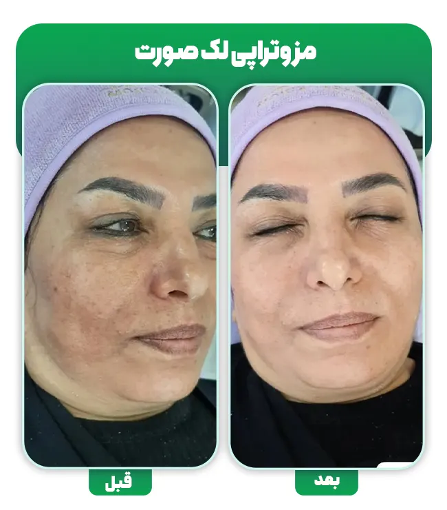 مزوتراپی لک صورت